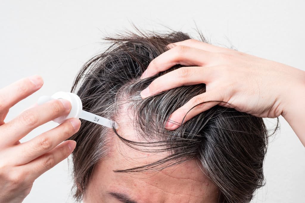 Topico Minoxidil Tópico: O que é e para que serve?
